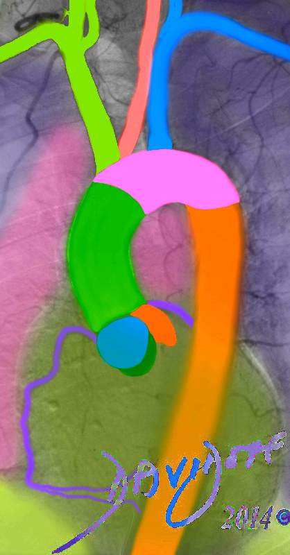 Thoracic Aorta Art In Anatomy